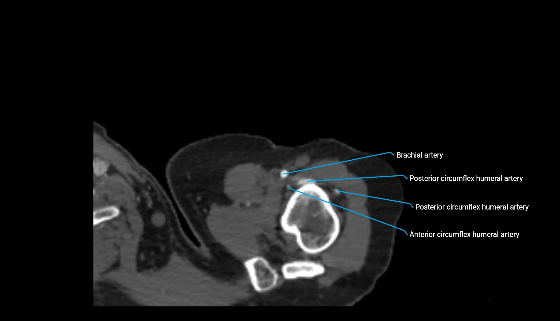 CTA upper limb axial cross sectional anatomy labelled image 317 (1).webp